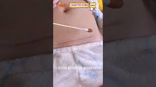 Download lagu C-Section Waterproof Incision Patch: Protect Your Healing Scar in Every Shower #MomTips #CSection mp3 Download lagu C-Section Waterproof Incision Patch: Protect Your Healing Scar in Every Shower #MomTips #CSection mp3
