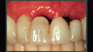 So sánh cầu răng và implant