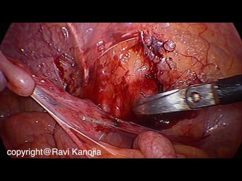 Orquiopexia laparoscópica de Fowler-Stephens en dos etapas en el tratamiento de los testículos intraabdominales