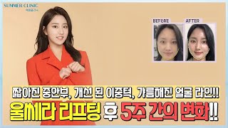 짧아진 중안부! 개선된 이중턱!! 갸름해진 얼굴라인!! | 울쎄라 5주간의 변화