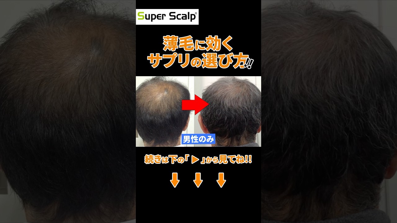 発毛促進に役立つ栄養素とは？薄毛サプリを紹介