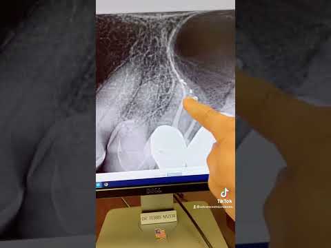Root canal therapy of a calcified tooth #13.