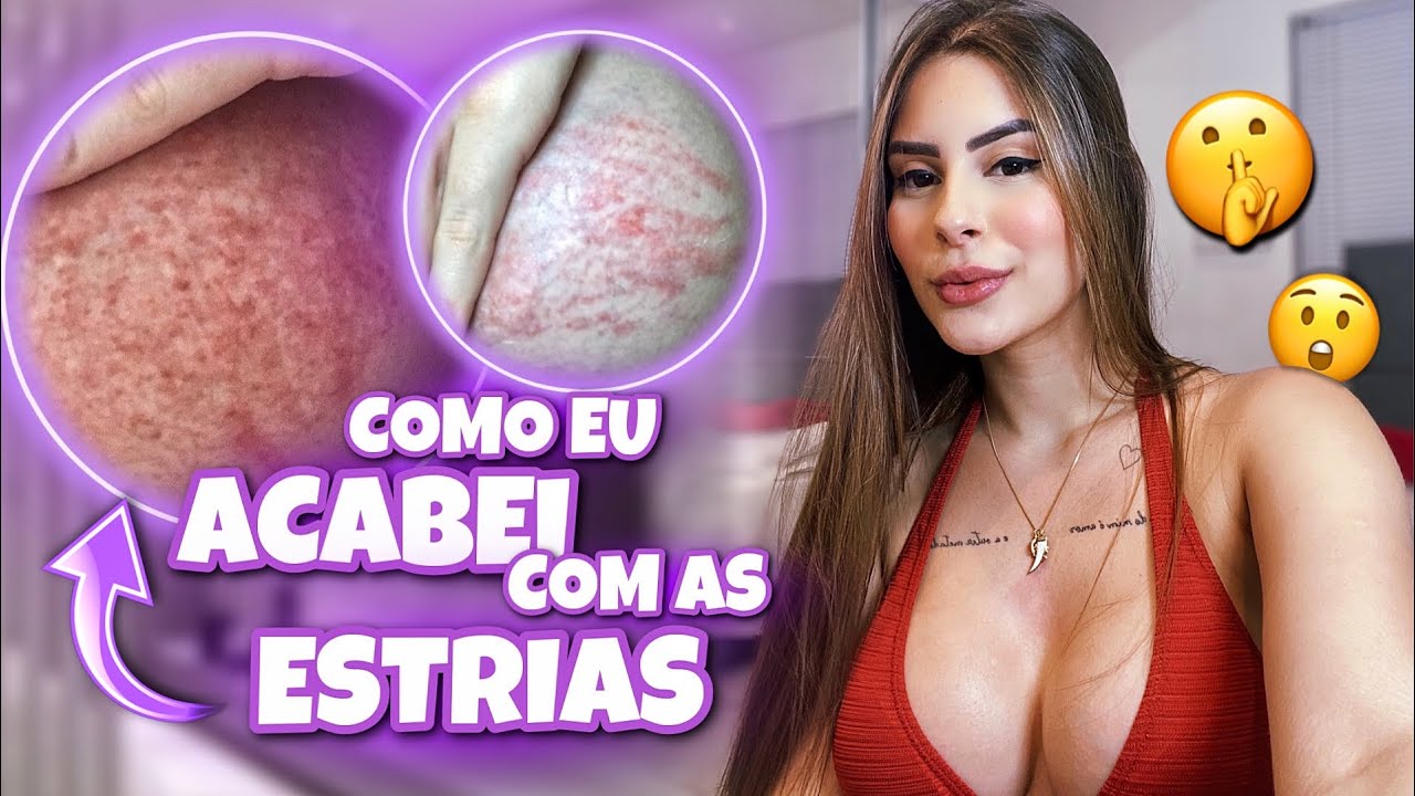 COMO EU ACABEI COM AS ESTRIAS - (RÁPIDO)