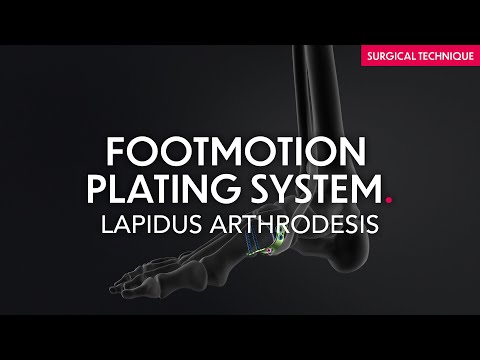 Surgical technique - Lapidus Arthrodesis - Footmotion Plating Sytem