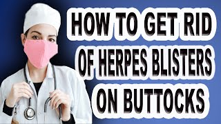 how to get rid of herpes blister on buttocks