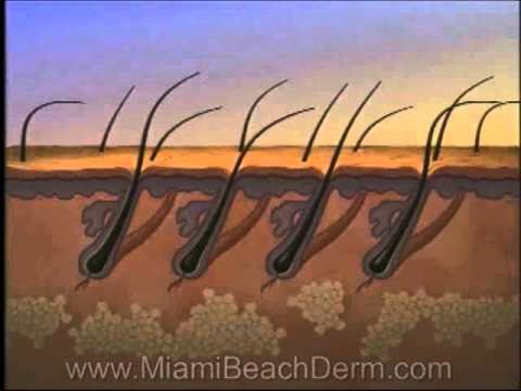 Laser Hair Removal Light Sheer Diode Lazer Miami Beach...