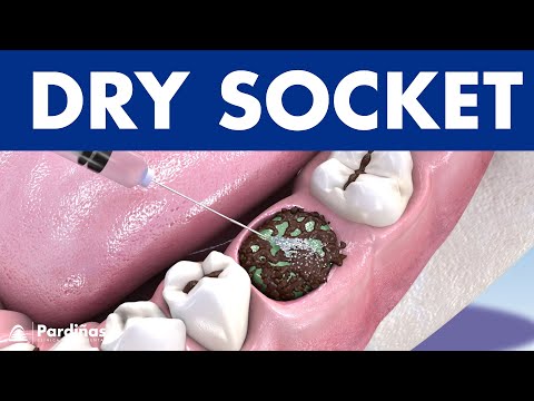 DRY SOCKET - Infection after tooth extraction: causes and treatment ©