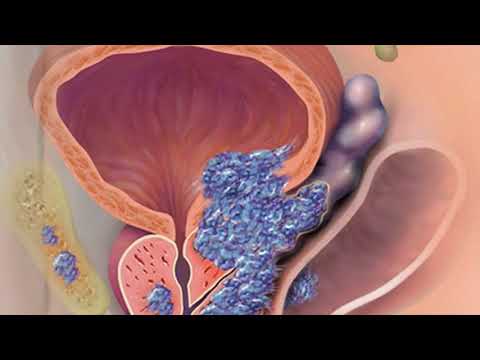 Ich habe chronische Prostatitis, wird der Vorgang tun Video Prostata Stimulator