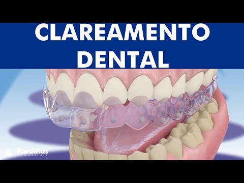 Clareamento dental ©