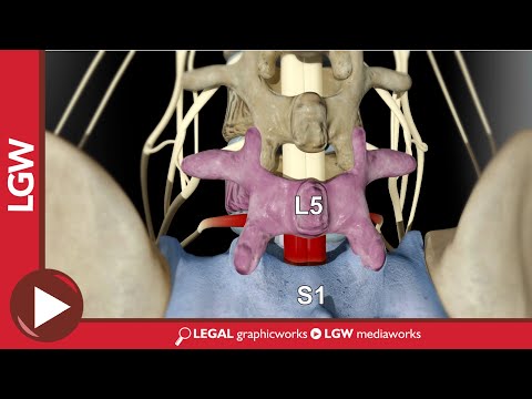 L5-S1 Posterior Lumbar Interbody Fusion 3D Animation
