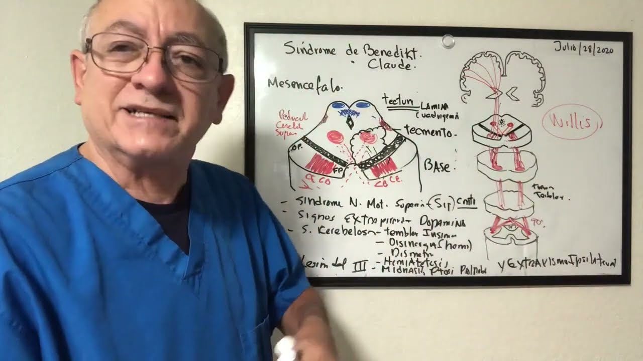 Síndrome de Benedikt y Claude  explicacion paso a paso. Repaso del mesencefalo
