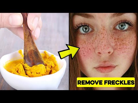 How to Get Rid of Freckles on Your Face at Home | 3 Home ...
