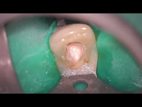 Calamus®  – Warm Vertical Master Cone Fit | Dentsply Sirona