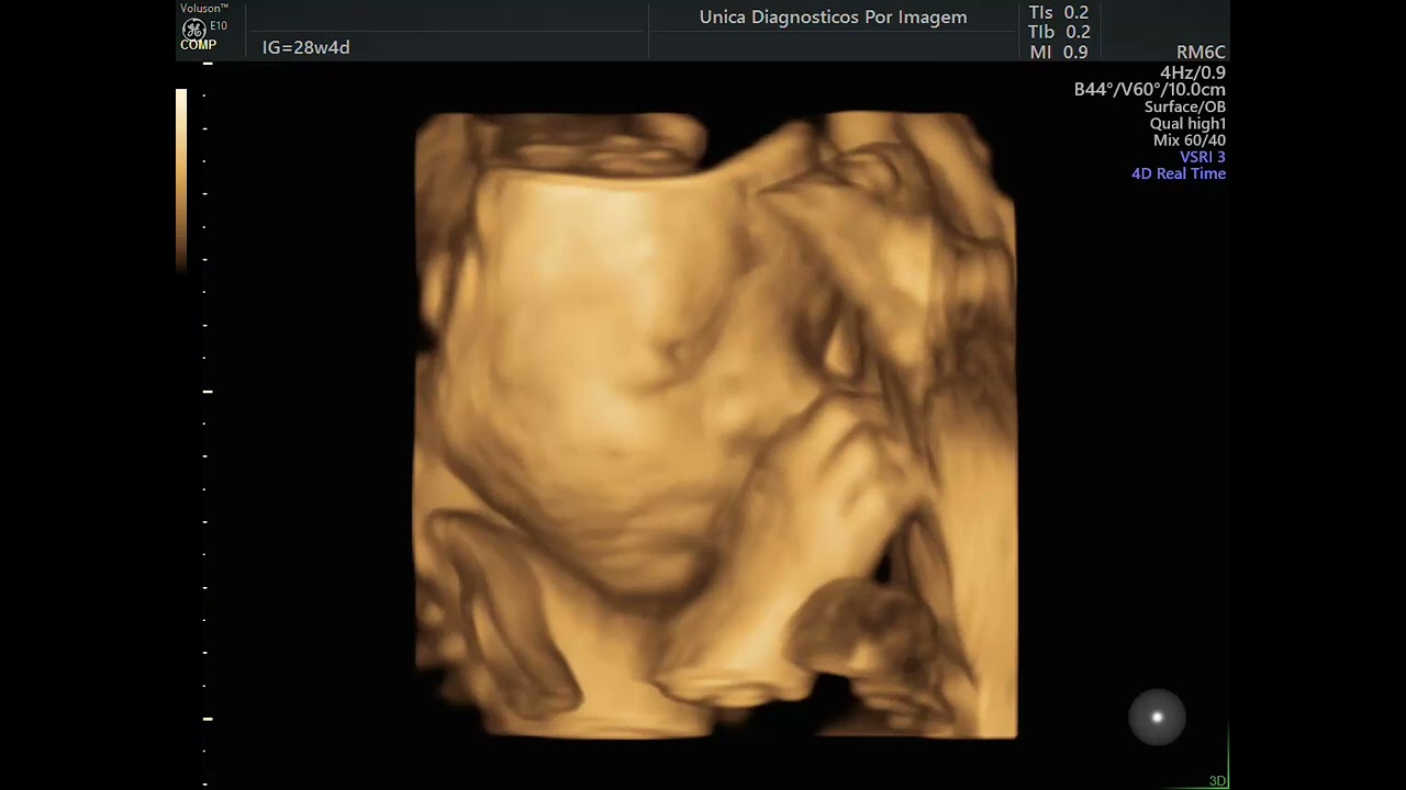 Ultrassom 3D-4D - 2