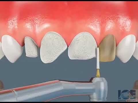 How to prepare and install vinyl or lenses.😁🤍