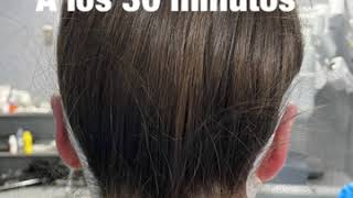 Otoplastia: buscando la naturalidad