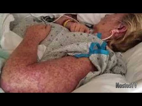 Parassita di salici di 2 video Come cè un organismo helminths morto