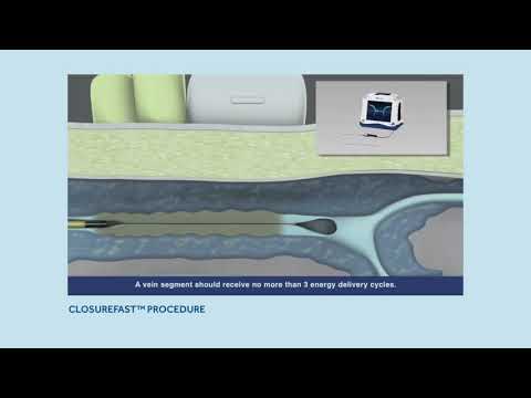 CLOSURE FAST PROCEDURE - Radiofrequency Ablation (RFA)