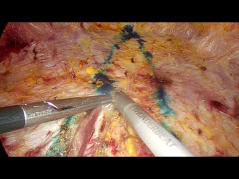 TESAR for distasis recti step by step