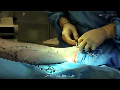 Kriocentrum - Usuwanie Żylaków