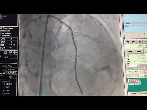 Antegrade approach and Provisional strategy and TAP stenting for LAD CTO and LMCA disease