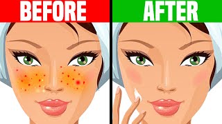 How to Get Rid of Acne OVERNIGHT