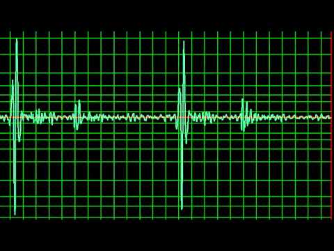 Aortic Regurgitation, Ejection Systolic Murmur- slow