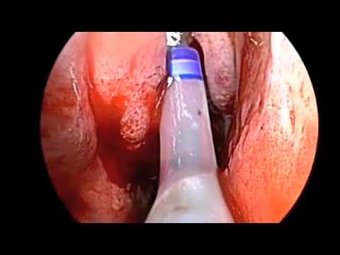 Lumina Light Cable - Device for Frontal Balloon Sinuplasty