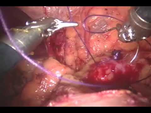 Robotic Partial Kidney Removal – Ischemia Reducion Due To Early Unclamping Method Application
