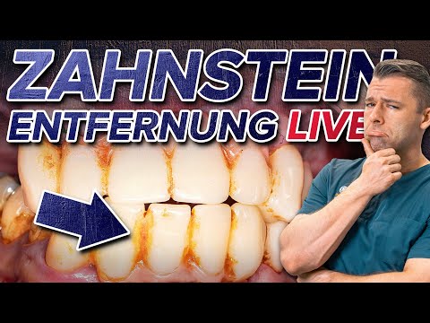 Zahnsteinentfernung LIVE  - So läuft es ab! Trotz Angst Zahnstein loswerden ✅