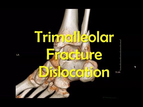 <h1 class=title>Trimalleolar Ankle Fracture Dislocation Reduction</h1>