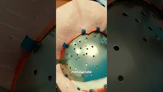 Download lagu The Metal Plate That Saved His Life 😮 Surgeon Reacts mp3
