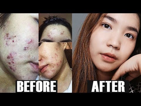 Ano ang gamot ay pinakamahusay na ng kuko halamang-singaw Presyo mikozan parmasya Voronezh