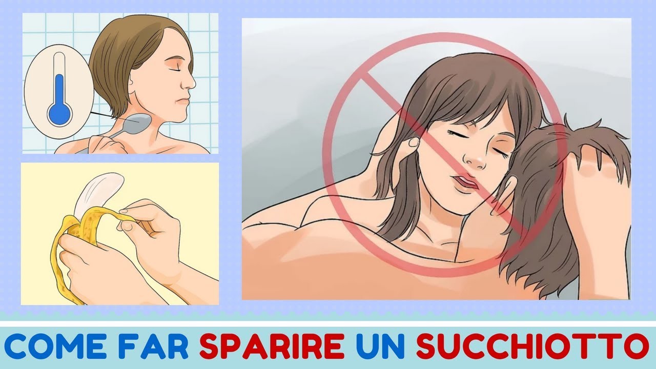 Watch Now SUCCHIOTTO: COME FARLO SPARIRE COMPLETAMENTE SUCCHIOTTO: COME FARLO SPARIRE COMPLETAMENTE