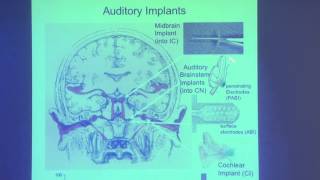 18. Hearing loss; demo by Sheila Xu, cochlear implant user