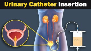 Foley Catheter insertion and purpose  Animation 