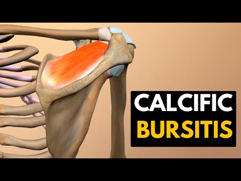 Calcific Bursitis, Causes, Signs and Symptoms, Diagnosis and Treatment.