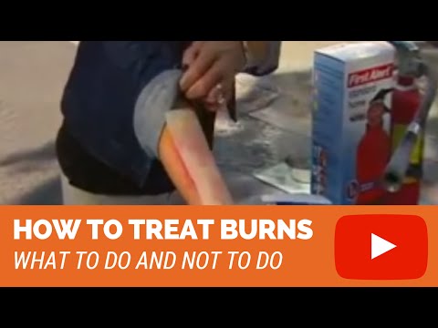 How To Treat Burns (2nd degree, 3rd degree burns)