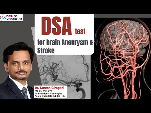 DSA Test for Brain Aneurysm & Stroke | Dr. Suresh Giragani