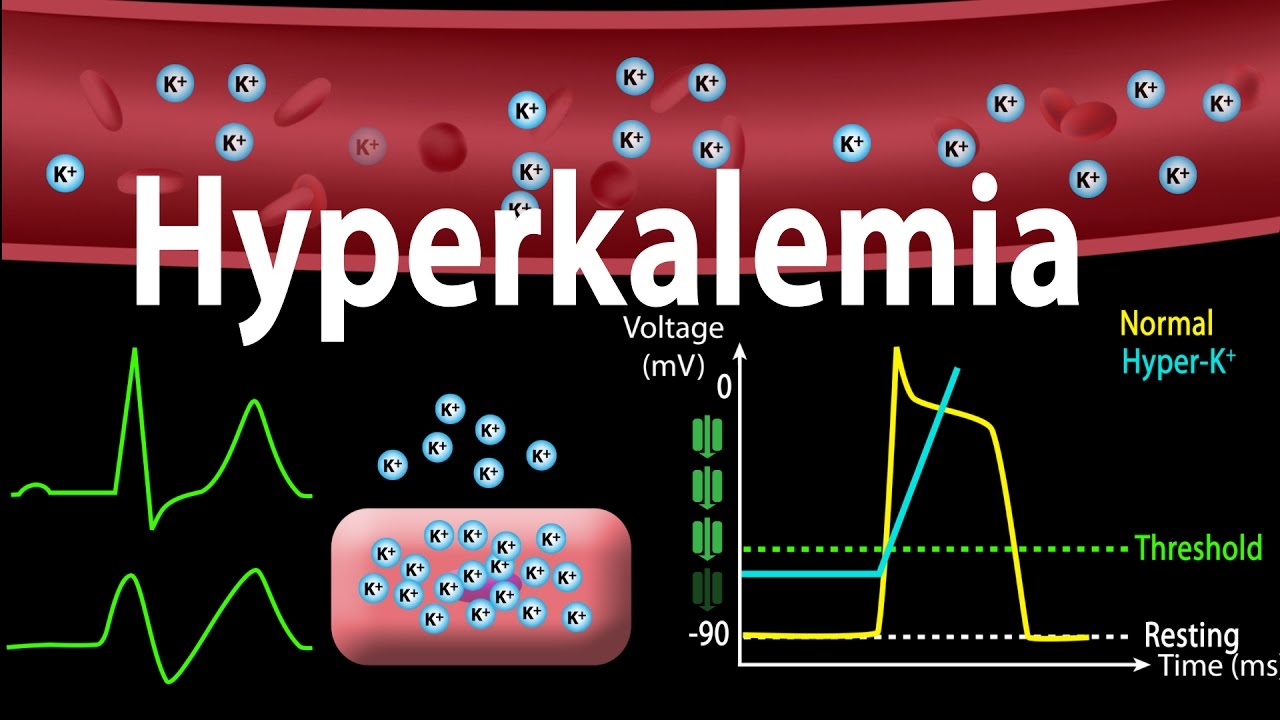 Hyperkalemia: Causes, Effects on the Heart, Pathophysiology, Treatment, Animation.