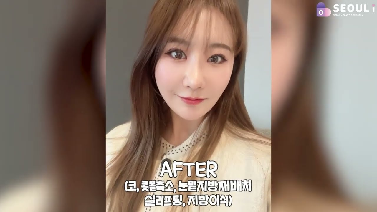 코, 눈밑지, 실리프팅, 지방이식 |서울아이성형외과 #성형전후