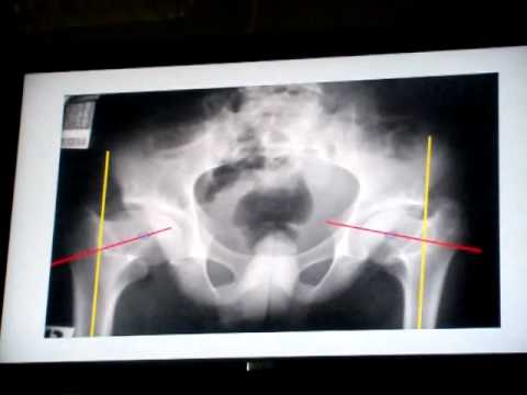 Erezione e lombari osteocondrosi