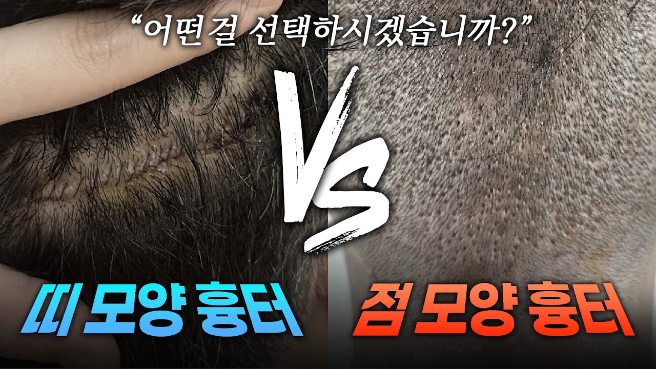 모발이식 절개 흉터 VS 비절개 흉터, 어떤 걸 선택하시겠습니까?