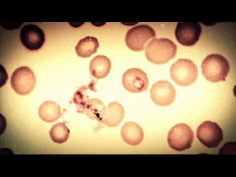 Babesiosis - Monsters Inside Me Ep7