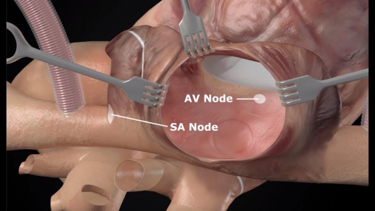 Training Videos: Maze Procedure & Left Atrial Appendage Occlusion Training Videos: Maze Procedure & Left Atrial Appendage Occlusion