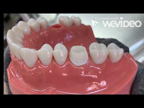 Full metal Crown preparation