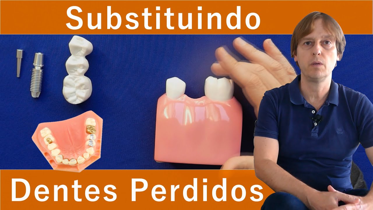 Substituindo Dentes Perdidos: Implante Dentário, Coroa Dental, Pivô [Parte 1] -  Qual a Diferença?