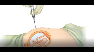 Amniocentesis and CVS Animation