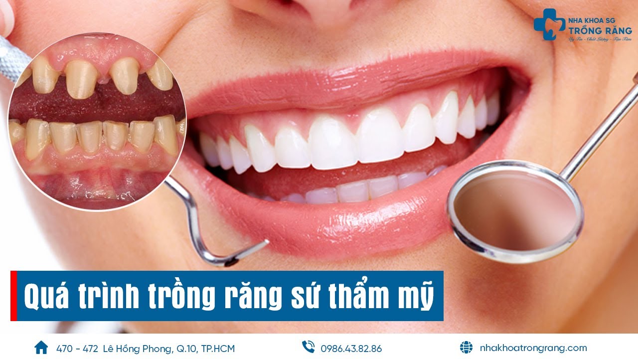 Trồng răng sứ thẩm mỹ - Quá trình trồng răng bị sâu, mẻ, gãy, vỡ