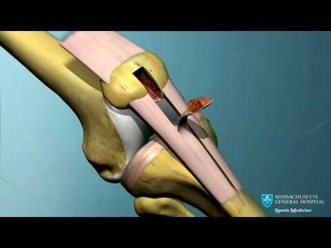 comment renforcer ligaments genoux